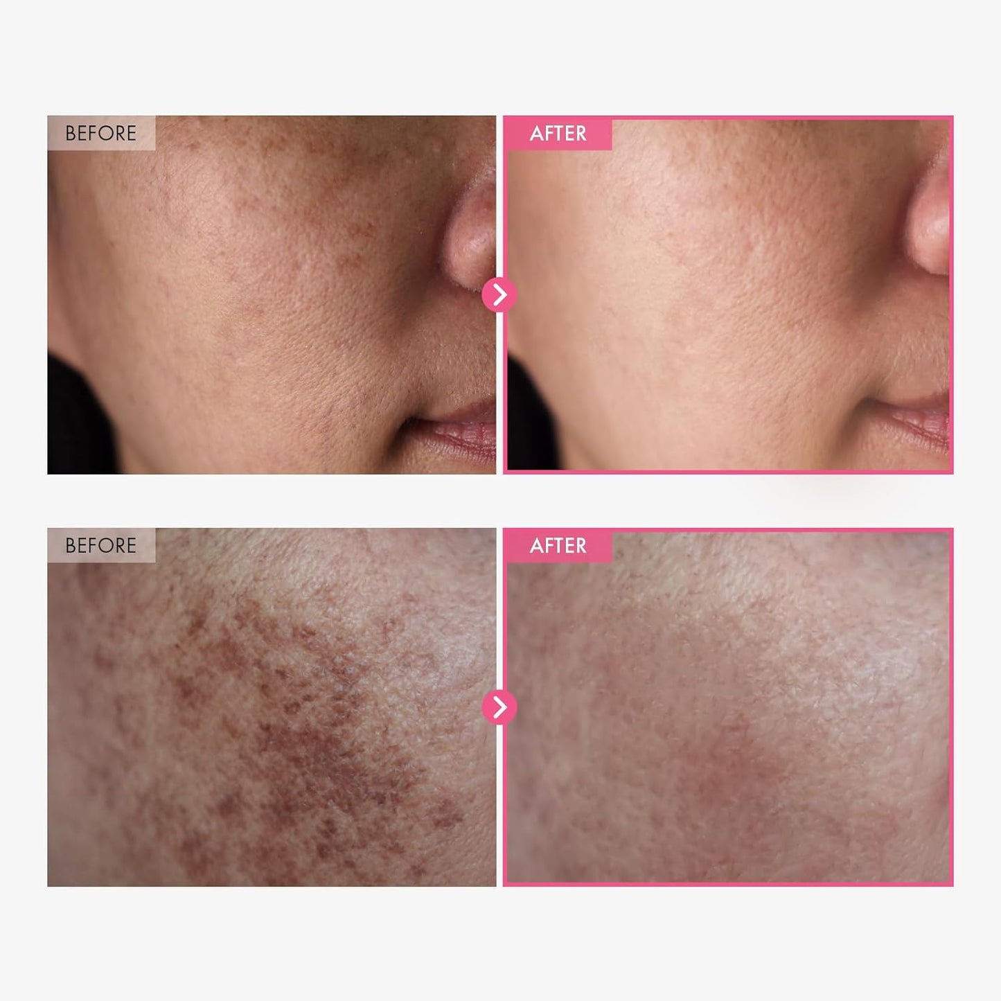 Korean Dark Spot Cream — Visibly Fades in 4 Weeks
