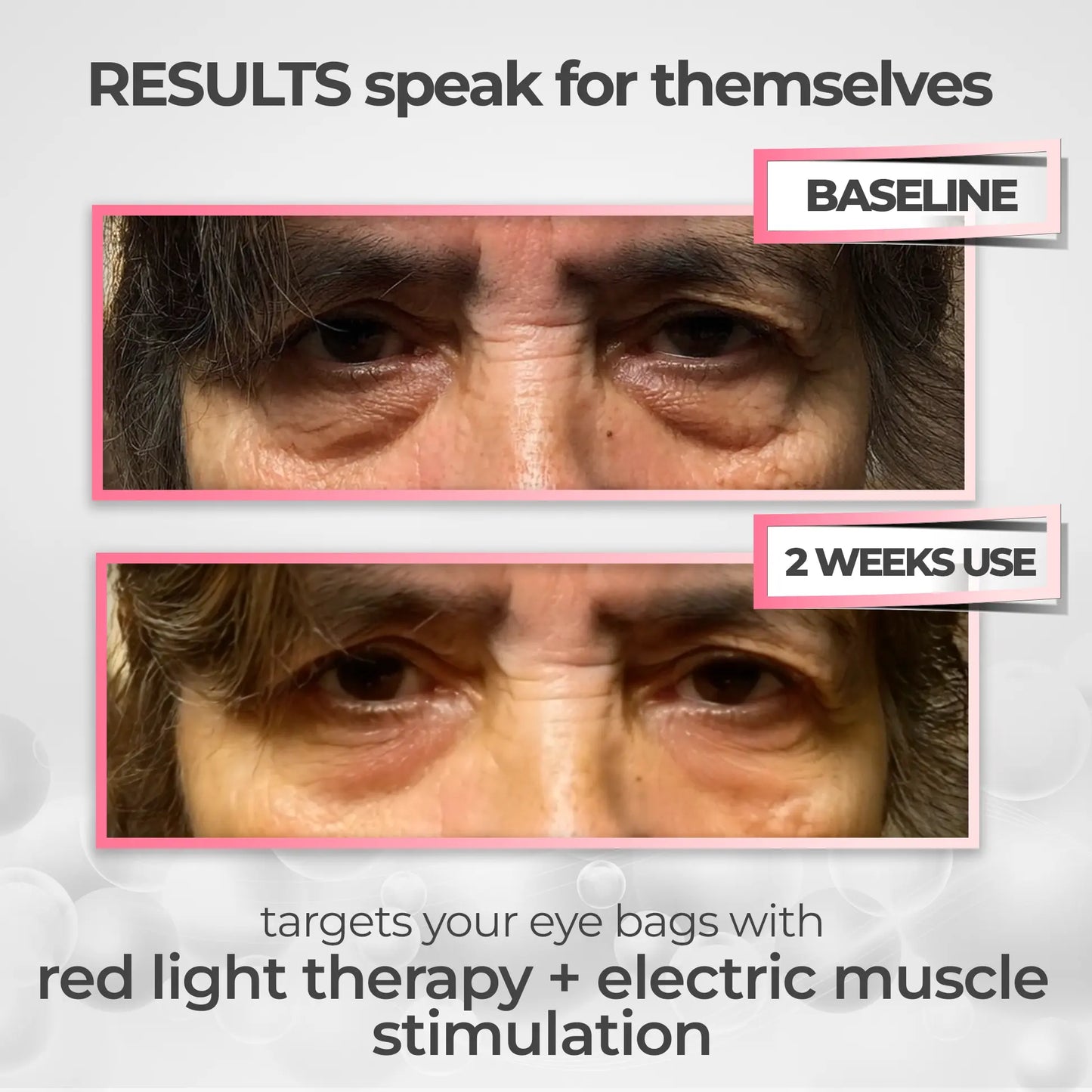 EyeLift Pro® 2-in-1 Red Light Therapy + EMS To Erase Eye Bags