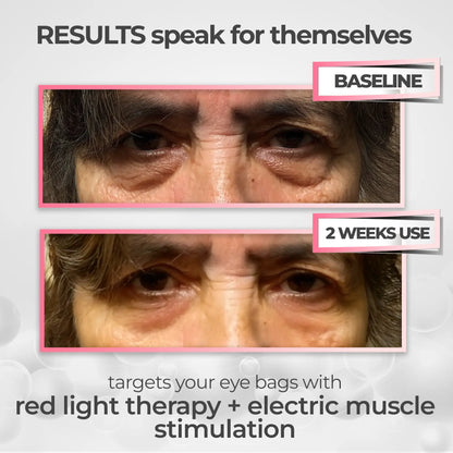 EyeLift Pro® 2-in-1 Red Light Therapy + EMS To Erase Eye Bags