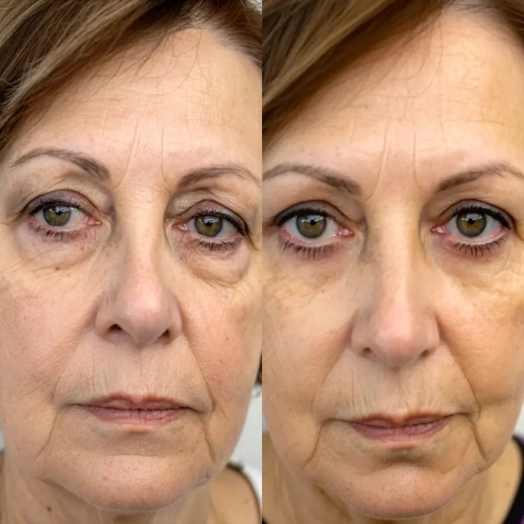EyeLift Pro® 2-in-1 Red Light Therapy + EMS To Erase Eye Bags