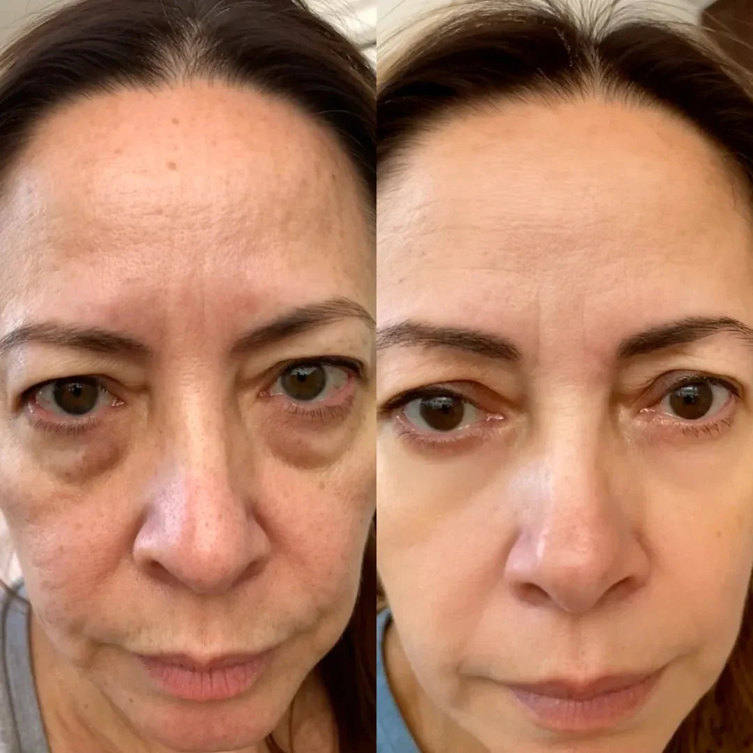 EyeLift Pro® 2-in-1 Red Light Therapy + EMS To Erase Eye Bags